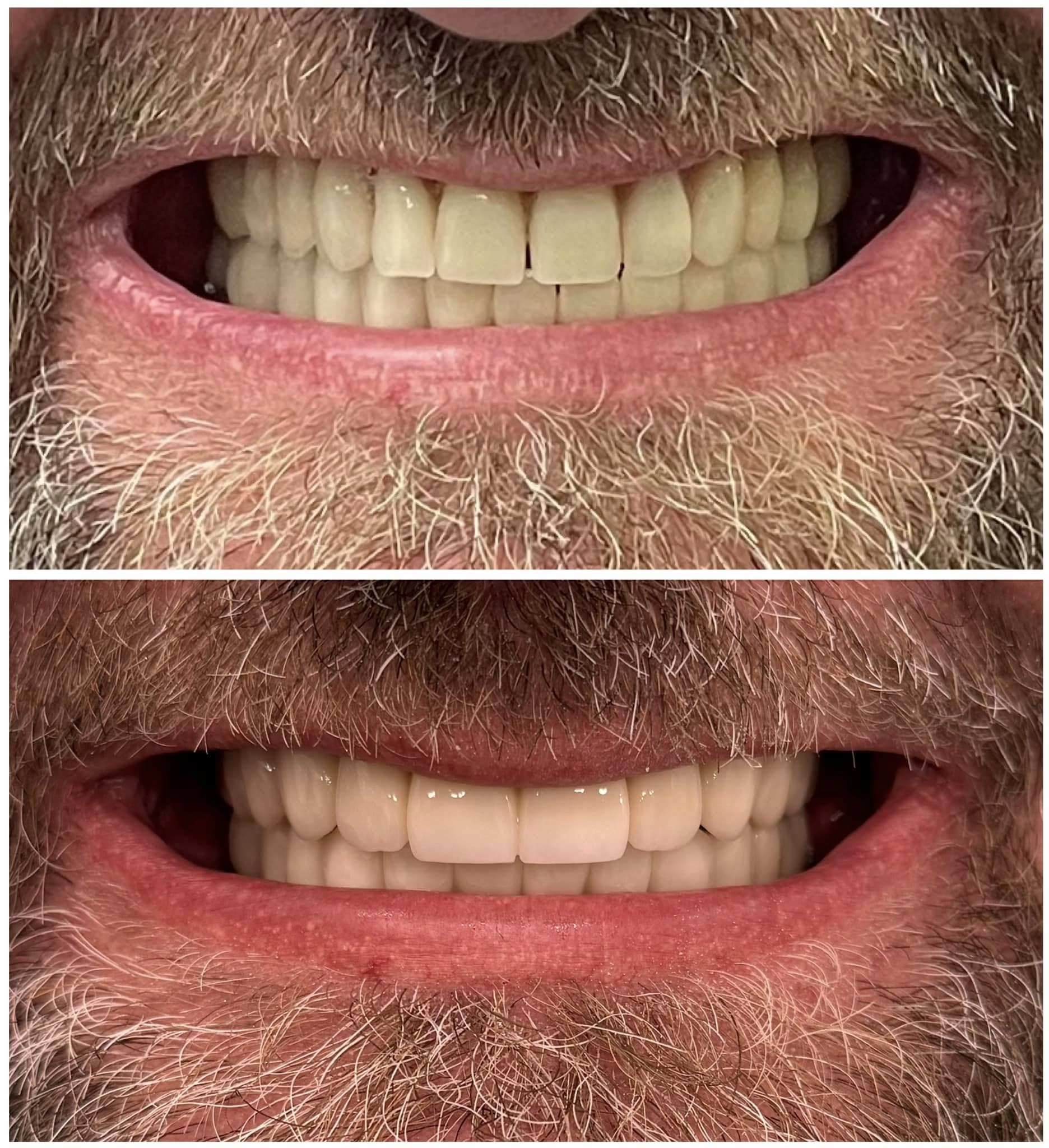 fiksna protetika – zahvat