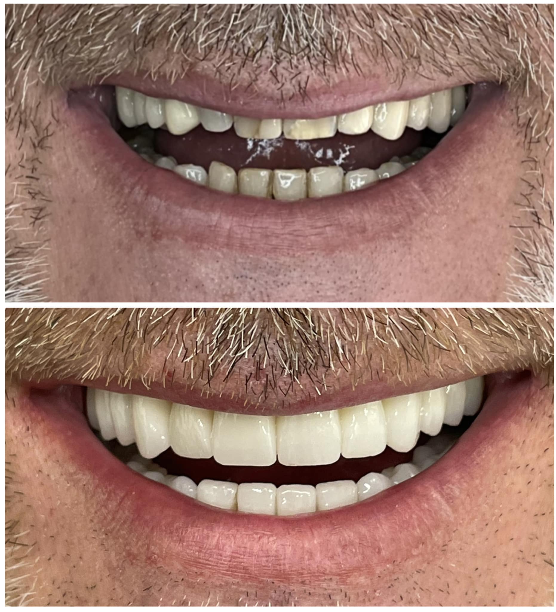 digitalno planiranje – priprema zuba