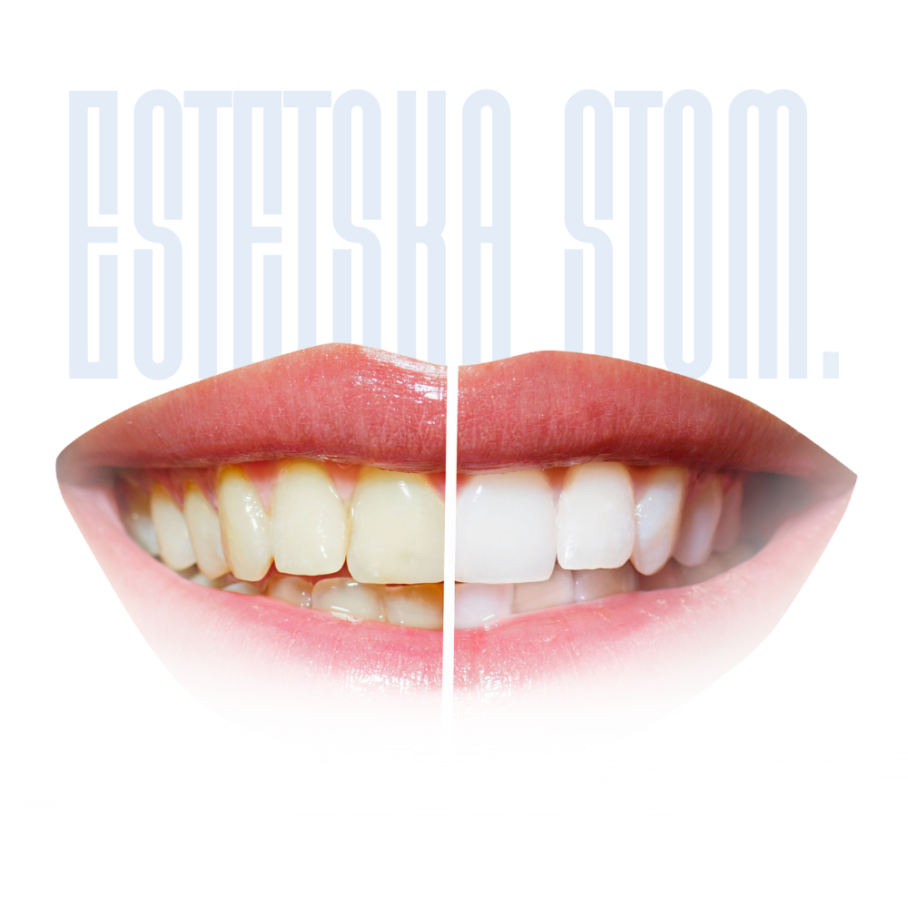 estetska stomatologija – fasete