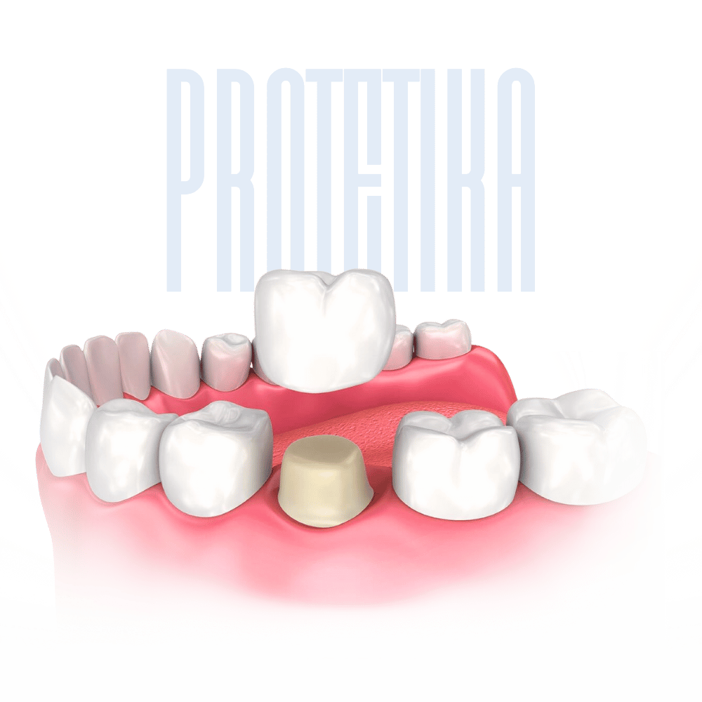 protetika – keramičke krunice
