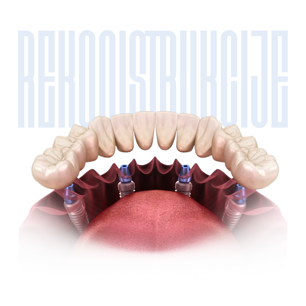 all-on-4 sistem – rekonstrukcija